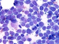 Lymphoma