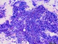 Mast cell tumor with abundant collagen
