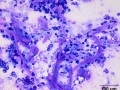 Mast cell tumor with abundant collagen
