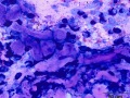 Mast cell tumor with abundant collagen