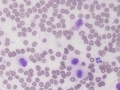 Mast cell tumor (DQ)