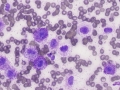 Mast cell tumor (DQ)