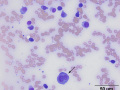 Myeloma (scapula)