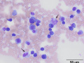 Myeloma (scapula)