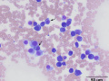 Myeloma (scapula)