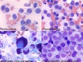 Round cell tumor compilation