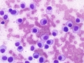 Extramedullary plasmacytoma (DQ)
