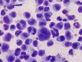 Histiocytic sarcoma, suspect (DQ)