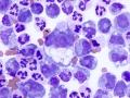 Suspect granulomatous inflammation
