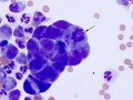 Reactive mesothelial cells