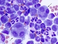Suspect granulomatous inflammation