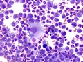 Suspect granulomatous inflammation