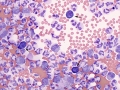 Reactive lymphocytes