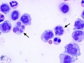 Dysplastic monocytes/macrophages