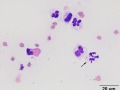 Septic peritonitis & eosinophils