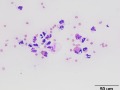 Septic peritonitis & eosinophils