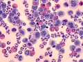 Exudate with eosinophils