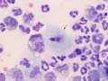Gastric rupture