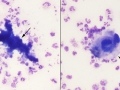 Colon rupture