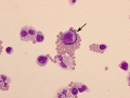Suspect lymphoma
