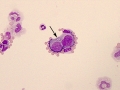 Suspect lymphoma