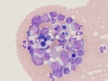 Lymphoma