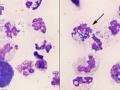 Colon rupture