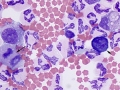 Reactive lymphocyte