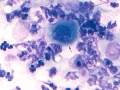 Squamous cell carcinoma