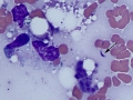 Toxoplasmosis