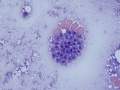 Toxoplasmosis