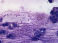 Klebsiella