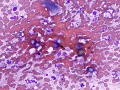 Blastomyces (DQ)
