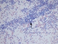 Mixed oral bacteria & microfilaria