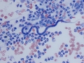 Mixed oral bacteria & microfilaria