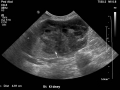 Suspect carcinoma (US)