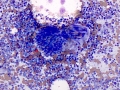 Lymphoma and glomerulus (cat)