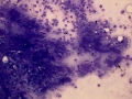 Lymphoma & histiocytosis