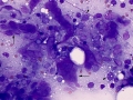 Lymphoma & histiocytosis