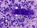 Lymphoma & tubule