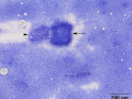 Glomerulus & lymphoma