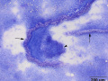 Proximal tubules & glomerulus & lymphoma