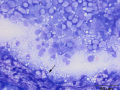 Proximal tubule and lymphoma