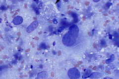 Mesenchymal tumors