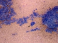 Fibrosarcoma (cat)