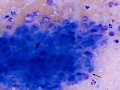 Suspect hemangiosarcoma (spleen)