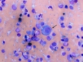 Suspect hemangiosarcoma (spleen)