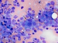 Suspect hemangiosarcoma (spleen)