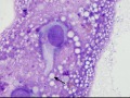 Chondroid-producing sarcoma