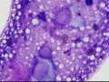 Chondroid-producing sarcoma